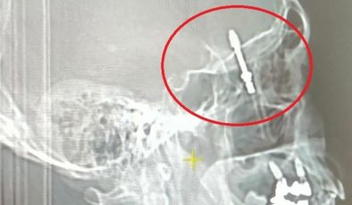 Bursa’da implant tedavisinde vida beynine saplandı