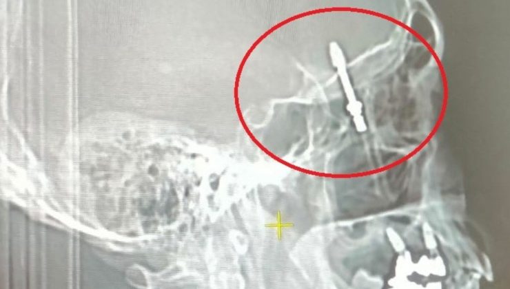 Bursa’da implant tedavisinde vida beynine saplandı